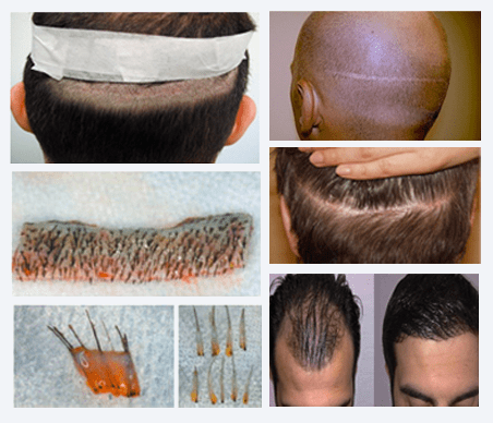 FUHT Hair Transplant in Pune