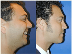 Facial Liposuction Surgery in Pune