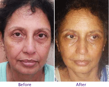 Facial Liposuction Recovery