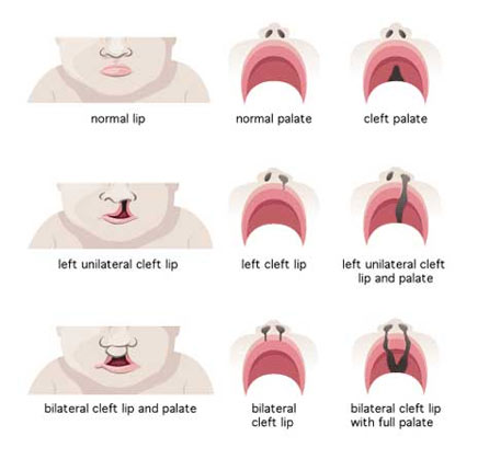 Lip Cleft Treatment Pune