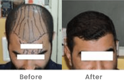 Hair Transplant Clinic in Pune