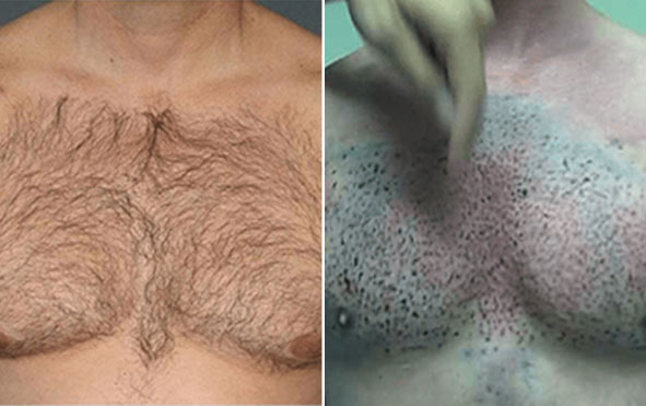 Body Hair Transplant in Pune