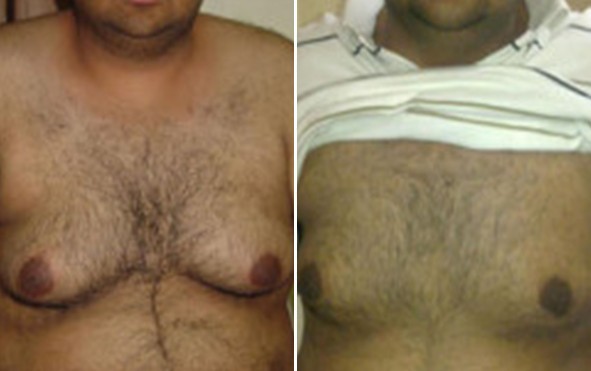 Gynaecomastia Pune