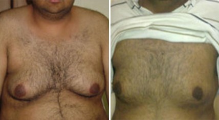 Gynaecomastia Surgery in Pune