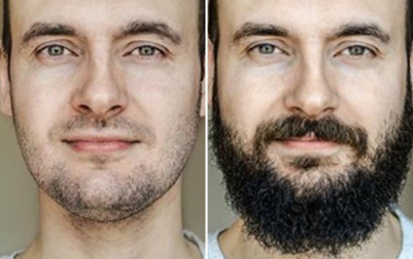 hair transplant in Pune Beard