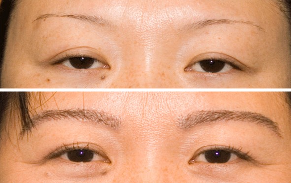 Eyebrow Transplant in Pune