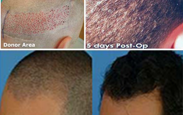 FUE Hair Transplant In Pune