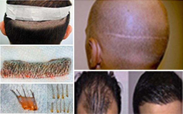 FUHT Hair Transplant in Pune