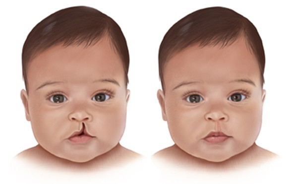 Lip Cleft Pune