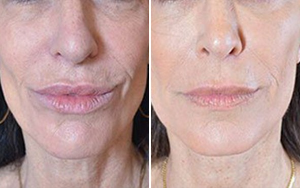 Non-Surgical Face Lifts