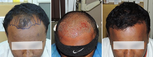 Pune Hair Loss Treatment