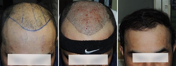 Best Hair Loss Treatment