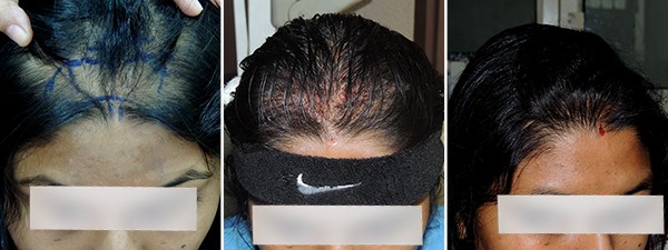 Women Hair Transplant Pune