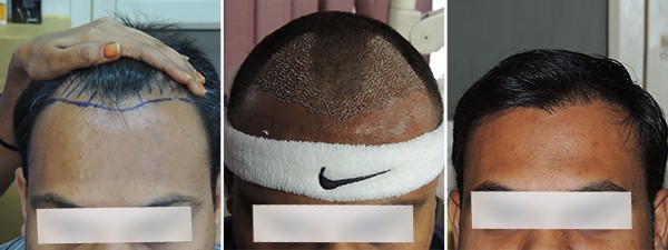 Hair Line Construction