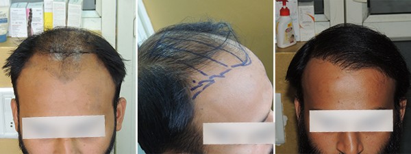 Pune Hair Transplant Treatment