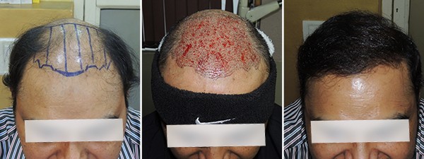 Hair Transplant Treatment