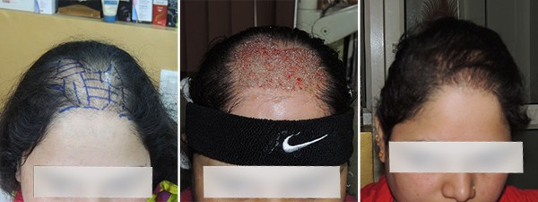 Women Hair Transplant