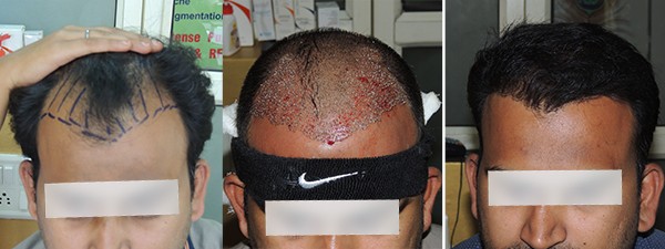 Best Hair Transplant Treatment