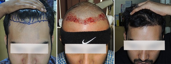 Hair Treatment In Pune