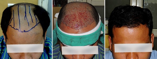 Hair Loss Treatment in Pune