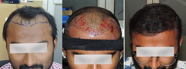 Hair Transplant Treatment in Pune