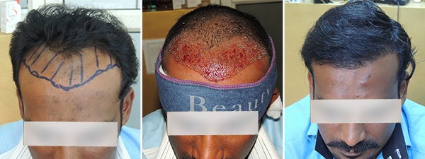 Hair Treatment in Pune