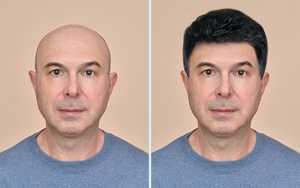 Hair-Transplant-Services Sai Cosmetics results